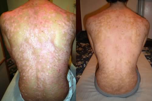 psoriasis  en la espalda antes y después del tratamiento con Reiki