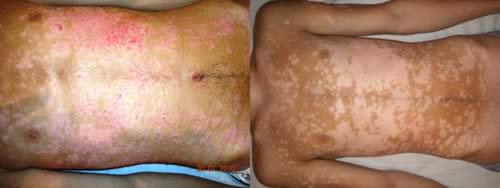 psoriasis  en el pecho antes y después del tratamiento con Reiki